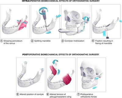 The Biomechanical Effect of the Sagittal Split Ramus Osteotomy on the Temporomandibular Joint: Current Perspectives on the Remodeling Spectrum